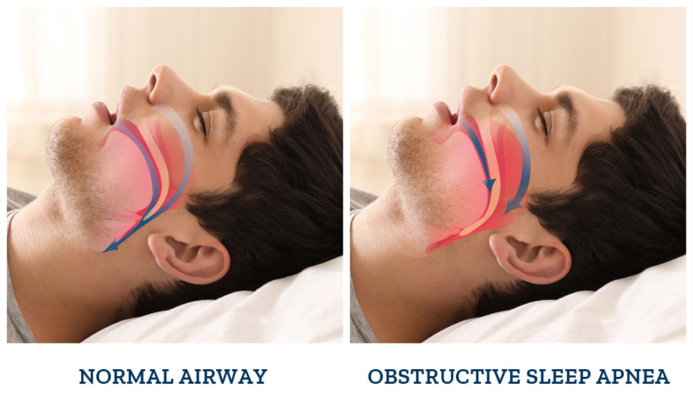 Airway Graphic | Comprehensive Sleep Services | CPAP Alternative | Sleep Apnea Treatment | Dallas | Fort Worth